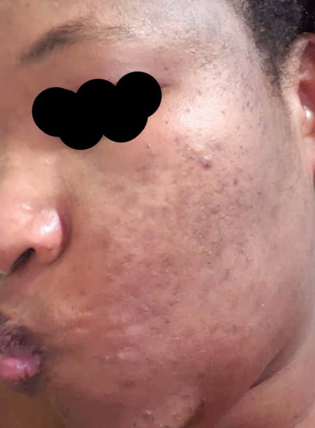 Acne Treatment - Toner to Get Rid of Blackheads - Big Deal Cosmetics