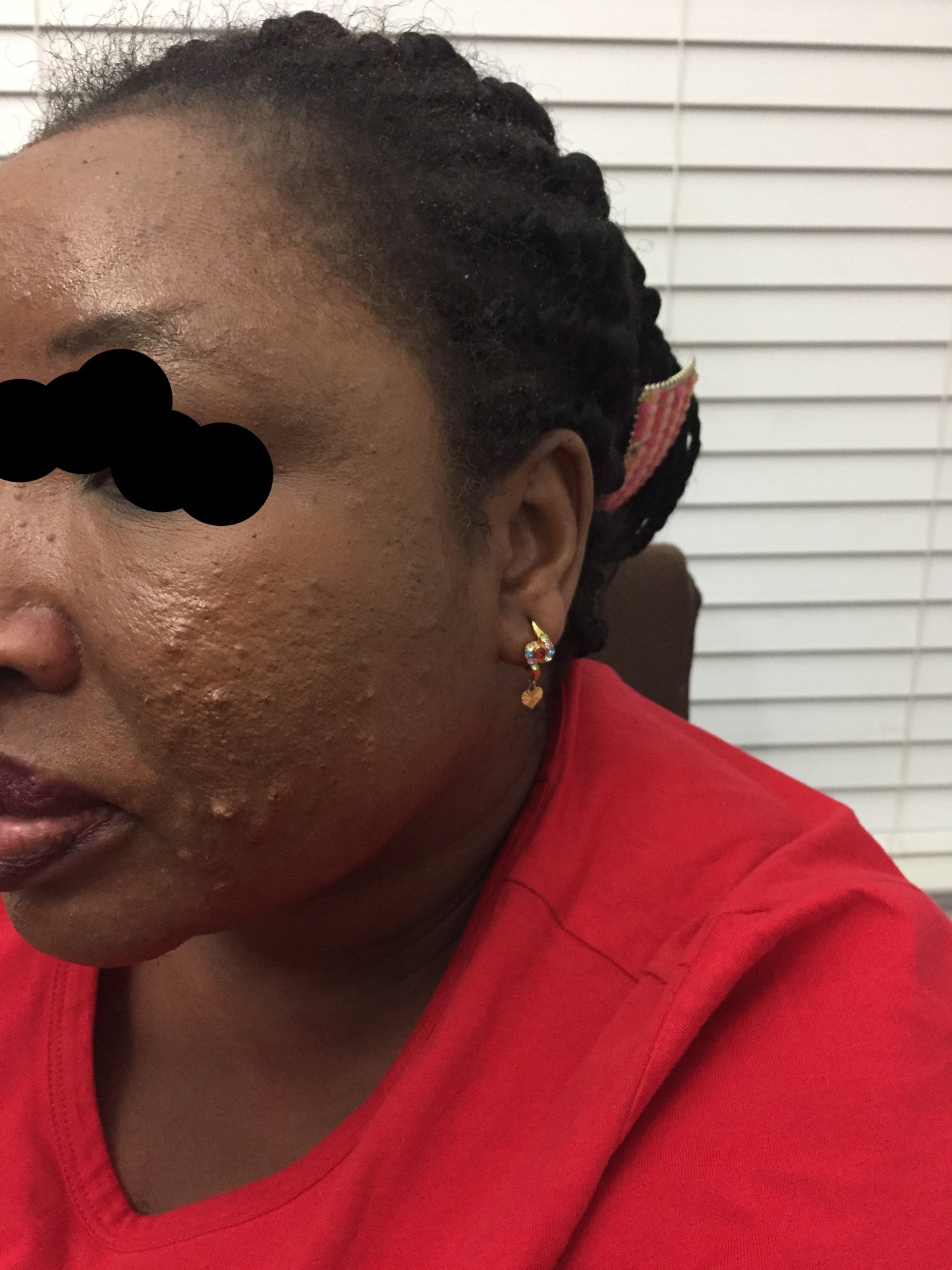 before and after pictures of severe acne